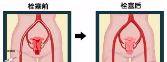 3子宫腺肌症子宫肌瘤2398.png