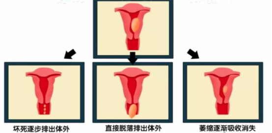 3子宫腺肌症子宫肌瘤2465.png