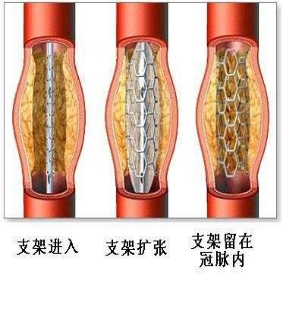 什么是冠脉造影检查646.png
